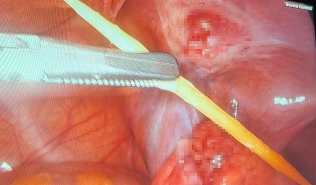 Sinop’ta 17 yaşındaki bir hastanın kalın bağırsağını delen kürdan kapalı yöntemle çıkarıldı